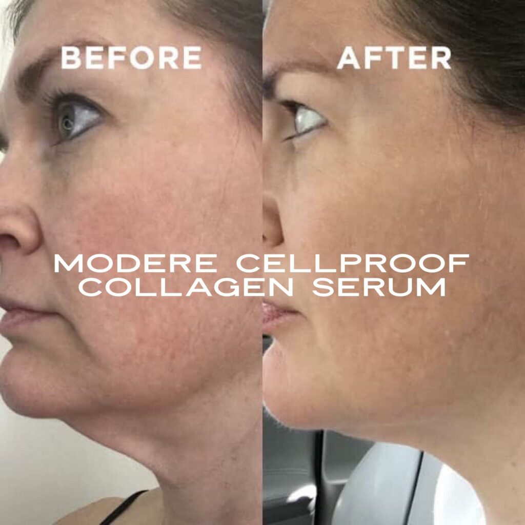 CellProof collagen serum Before and After photos of a neck waddle